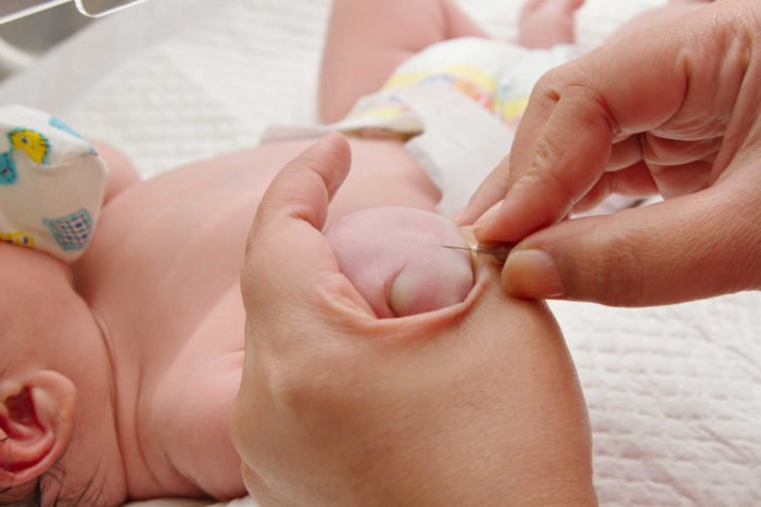 Thiếu axit ceramidase - Hình ảnh minh họa